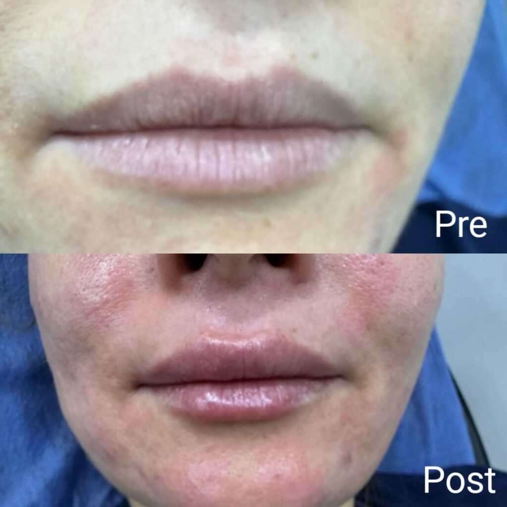 Lip filler injection